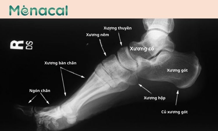 Cấu trúc xương bàn chân có thể thấy rõ qua ảnh chụp X quang