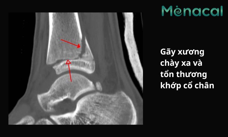 Hình ảnh gãy xương chày xa và tổn thương khớp cổ chân
