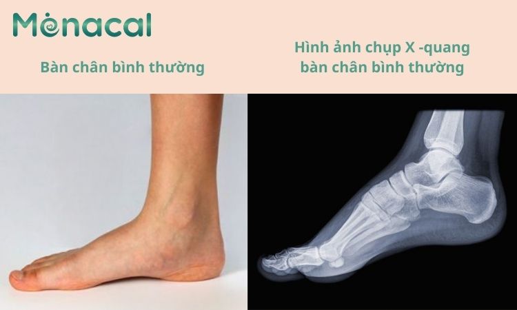 Hình ảnh xương bàn chân bình thường và kết quả chụp X - quang.