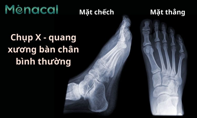 Mặt thẳng và mặt chếch của xương bàn chân bình thường qua X quang