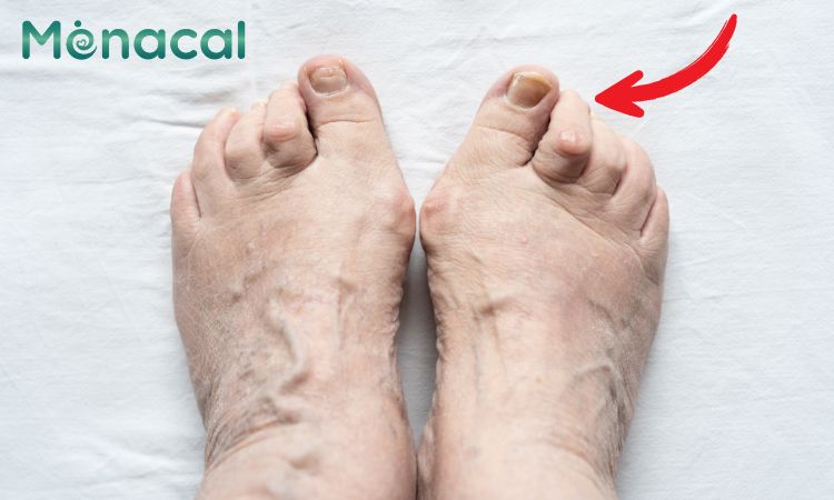 Ngón chân hình búa ảnh hưởng đến thẩm mỹ