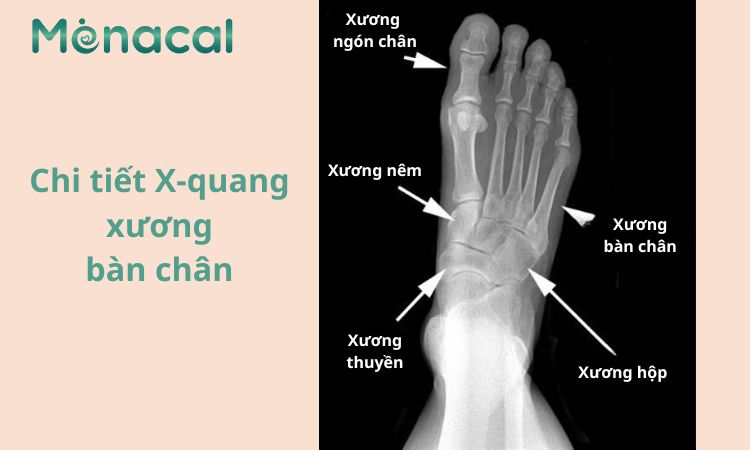 Một số giải thích chi tiết về hình ảnh chụp X quang xương bàn chân bình thường