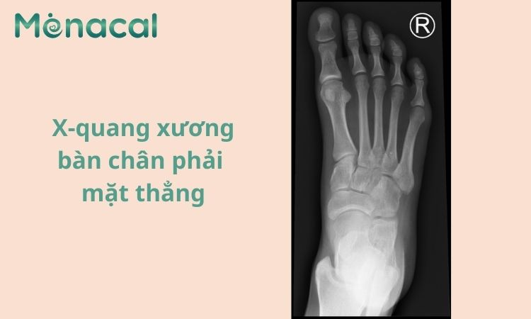 Hình ảnh X quang xương bàn chân phải mặt thẳng