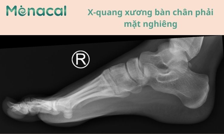 Hình ảnh X quang xương bàn chân phải mặt nghiêng