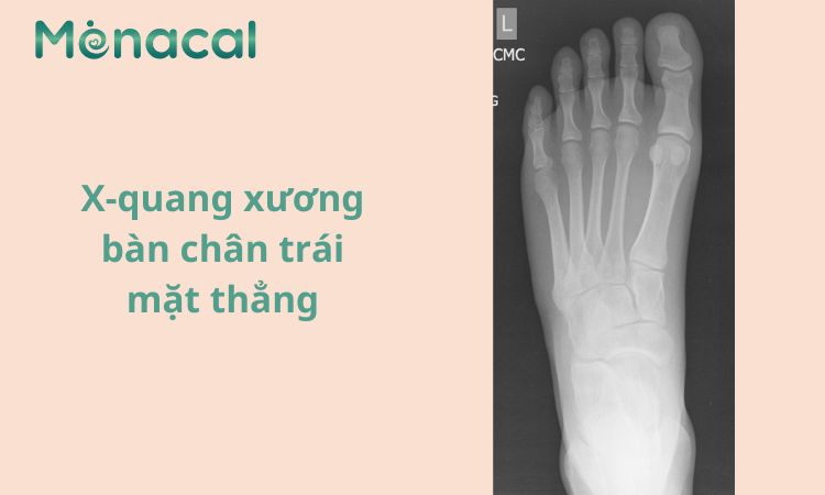Hình ảnh X quang xương bàn chân trái mặt thẳng