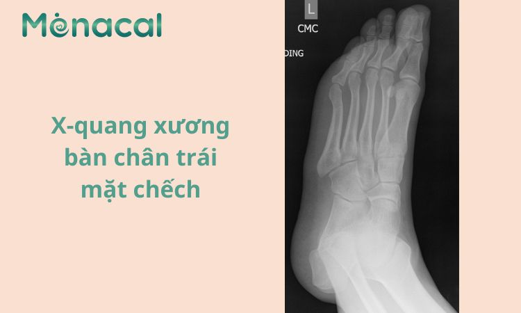 Hình ảnh X quang xương bàn chân phải mặt chếch