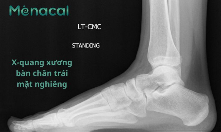 Hình ảnh X quang xương bàn chân trái mặt nghiêng
