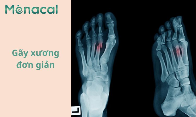 Gãy xương đơn giản: Một vết gãy đơn lẻ, sạch ở xương.