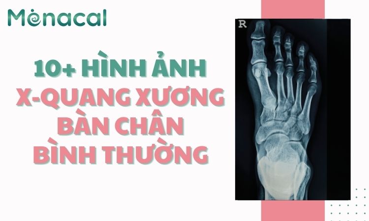 x-quang-xuong-ban-chan-binh-thuong (8)