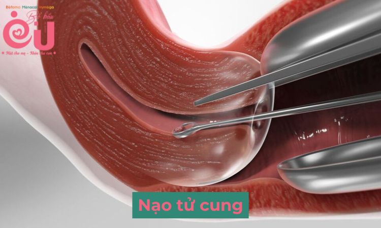 Nạo tử cung