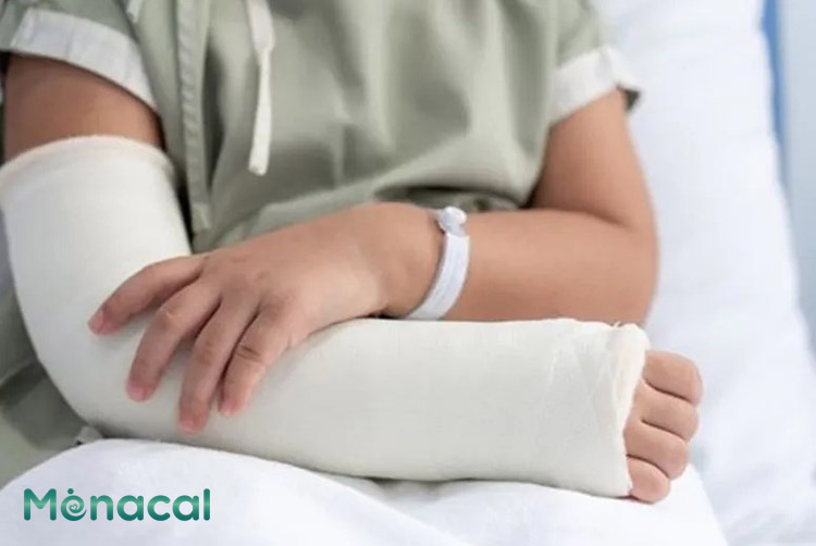 Chi phí mổ gãy xương tay ở bệnh viện công lập thường rẻ hơn bệnh viện tư nhân