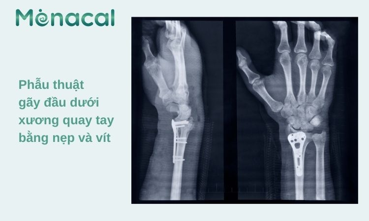 Thời gian phục hồi sau phẫu thuật thường nhanh hơn so với bó bột thông thường