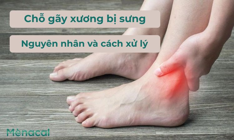 Chỗ gãy xương bị sưng