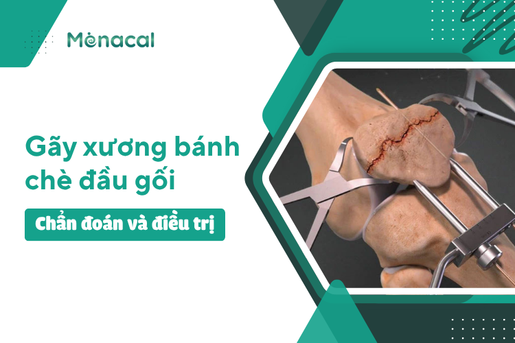 Gãy xương bánh chè đầu gối