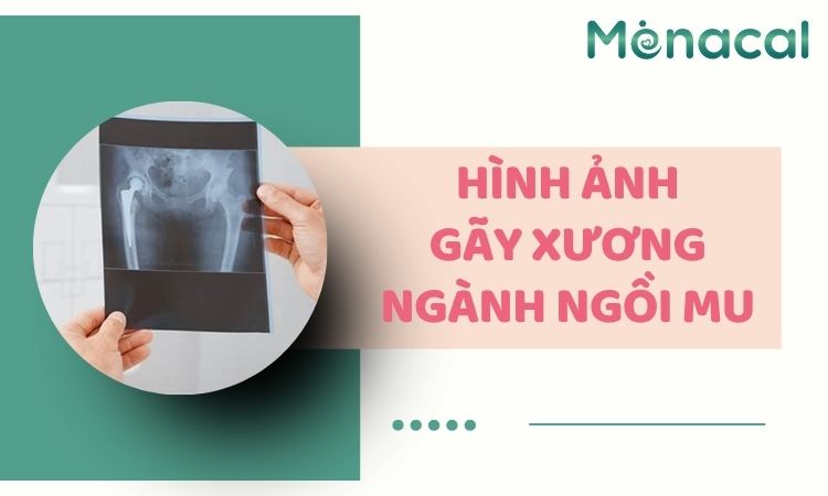 Hình ảnh gãy xương ngành ngồi mu