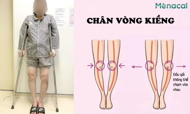 Chân vòng kiềng nặng, đi lại khó khăn cần dùng nạng