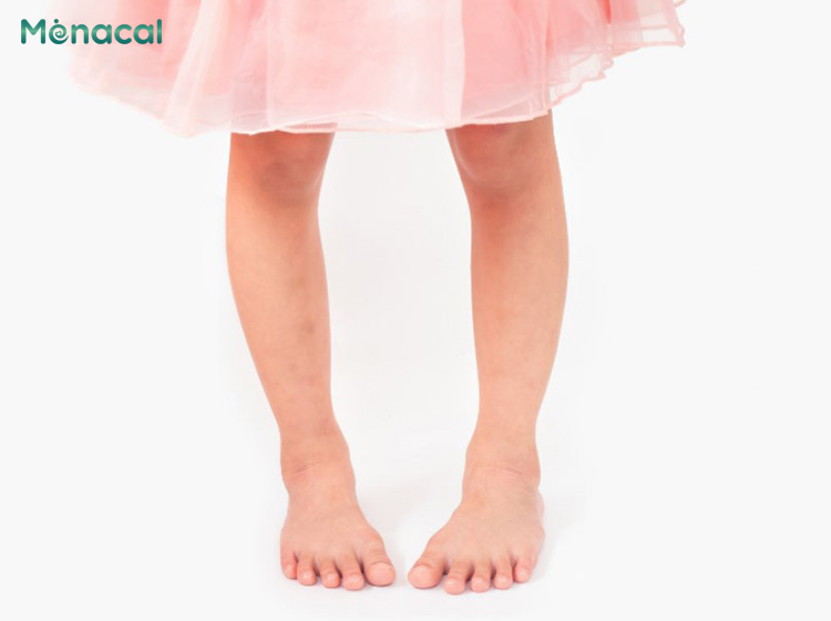 Chân vòng kiềng là hai chân cong khiến đầu gối không chạm nhau khi đứng thẳng
