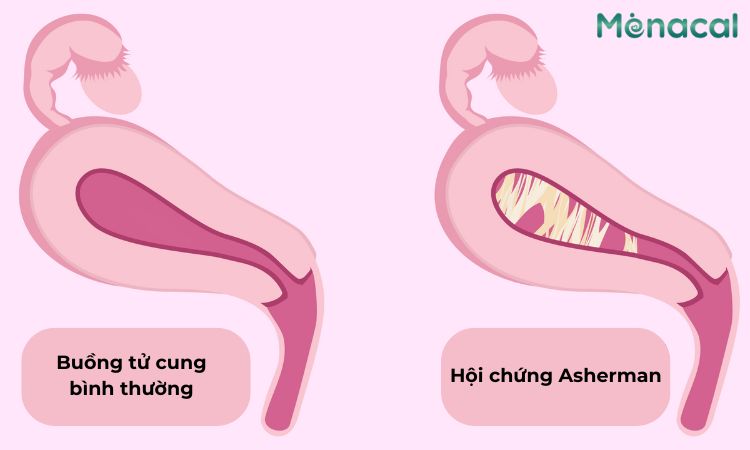 Hội chứng Asherman