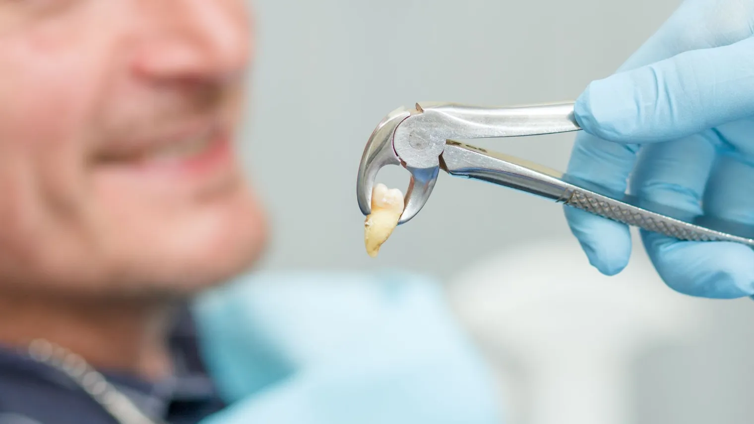 Tooth extraction procedure in Los Angeles