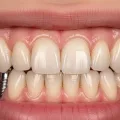 Expert Dental Implants for Long-Lasting, Beautiful Results