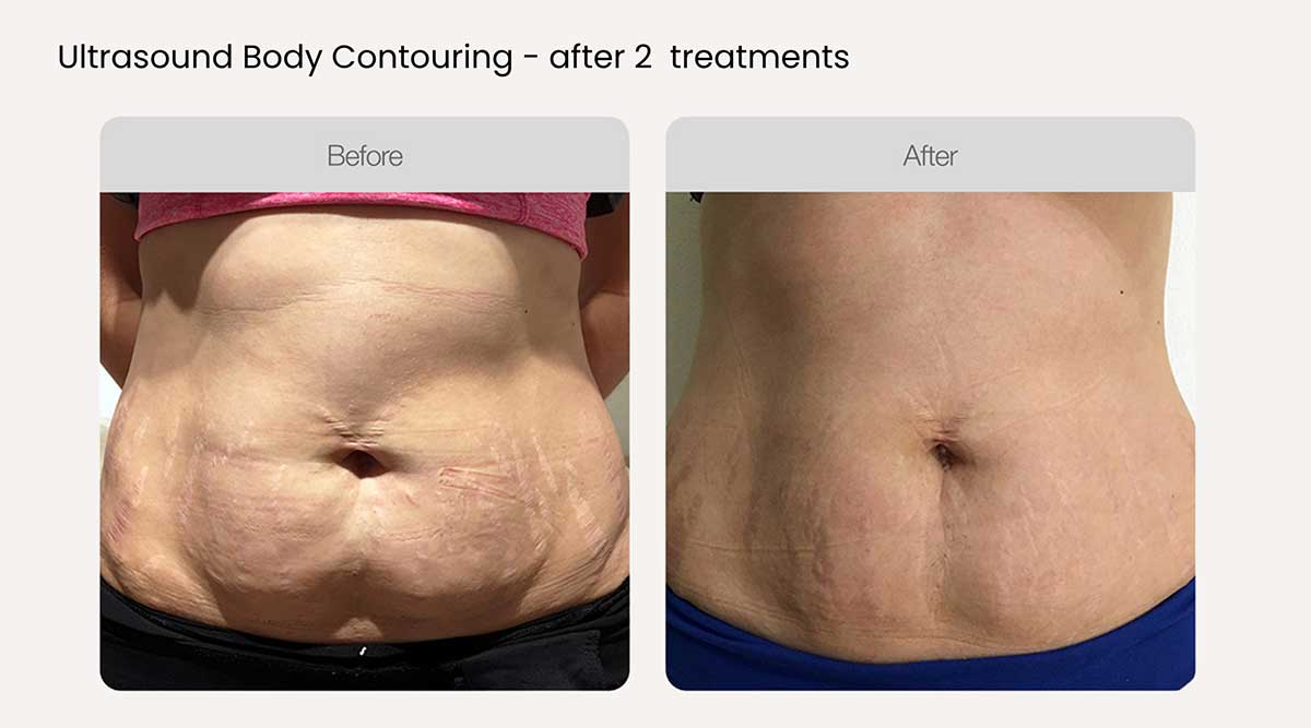 Body-Contouring