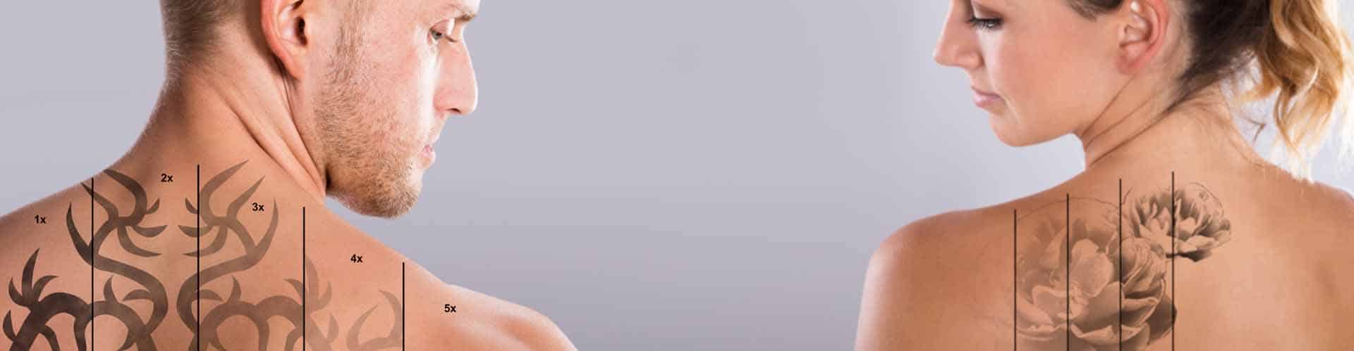 Tattoo Removal