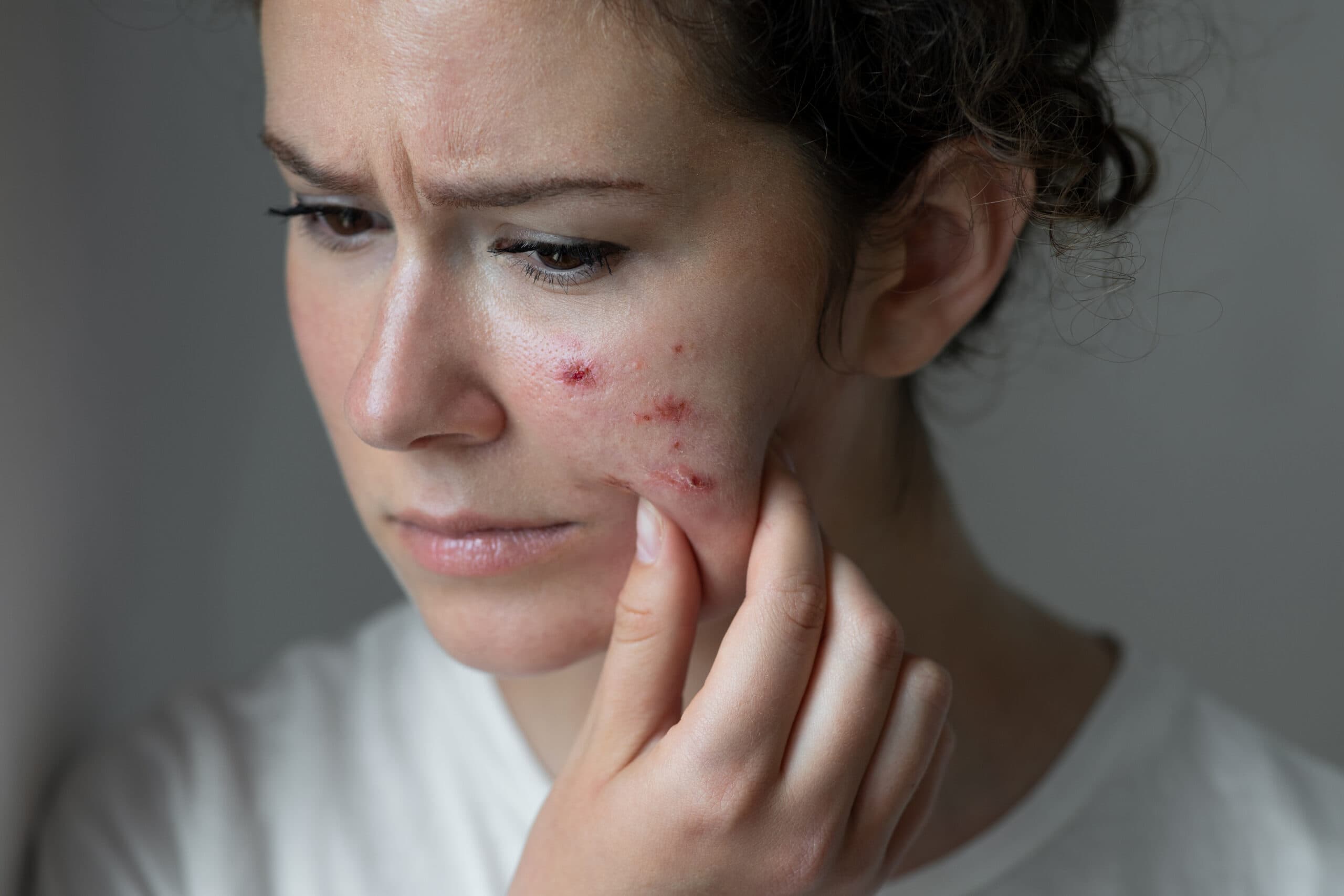 Young woman has problems with skin on the face