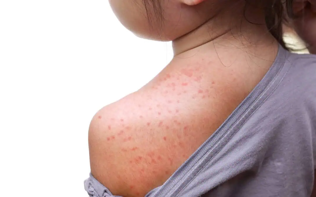 Understanding Measles: Symptoms, Spread, Complications & Vaccination