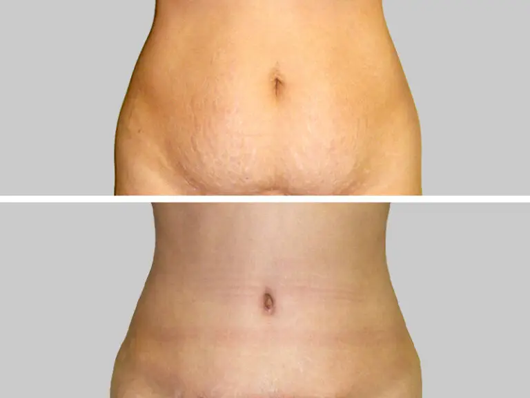 Before & After 4