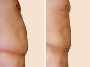 Lipo 2 B