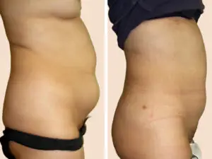 Lipo-5 A