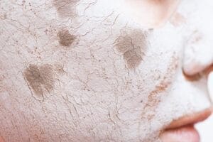 seboroicni dermatitis