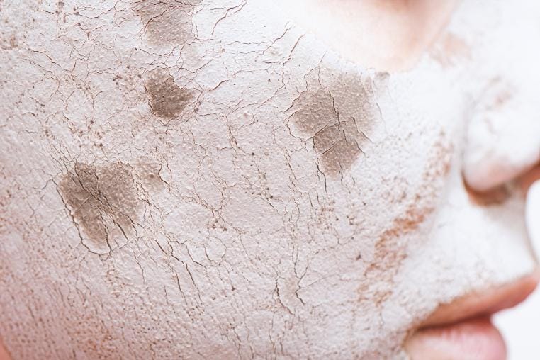 seboroicni dermatitis