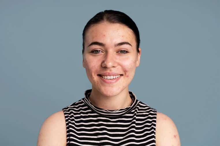 pubertetske bubuljice