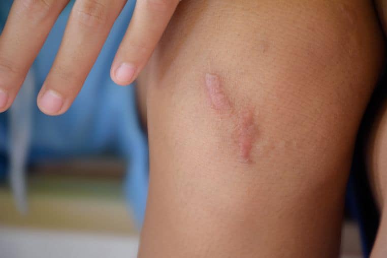 keloid
