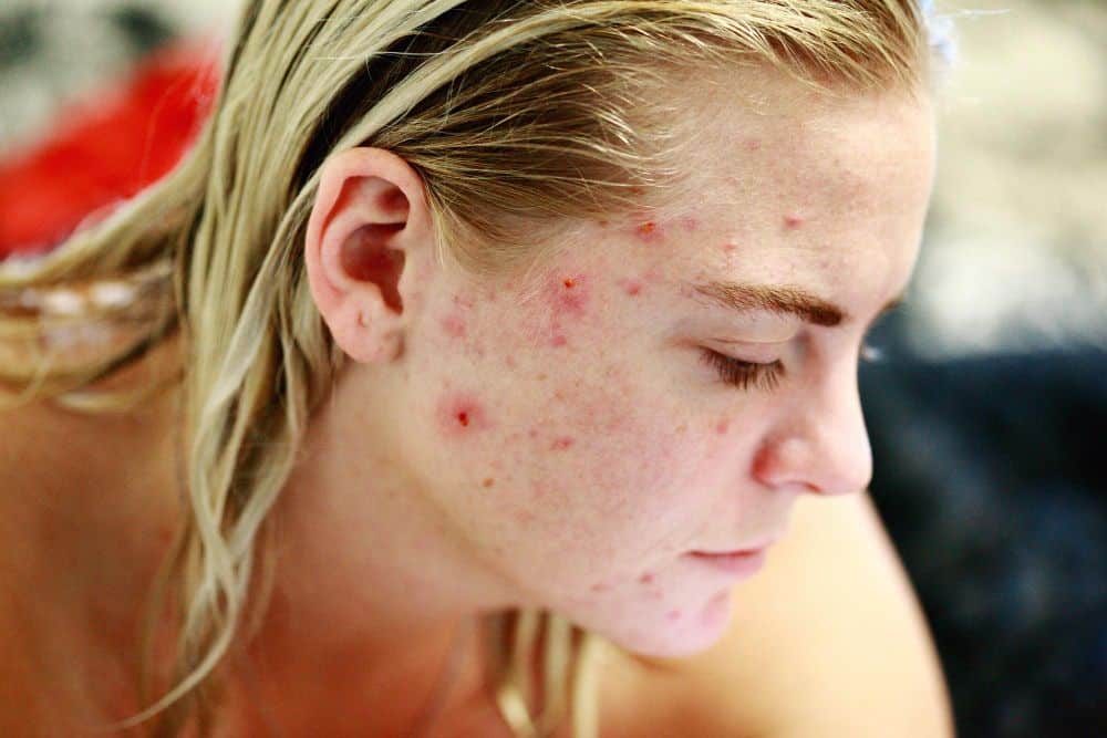 Acne Conglobata