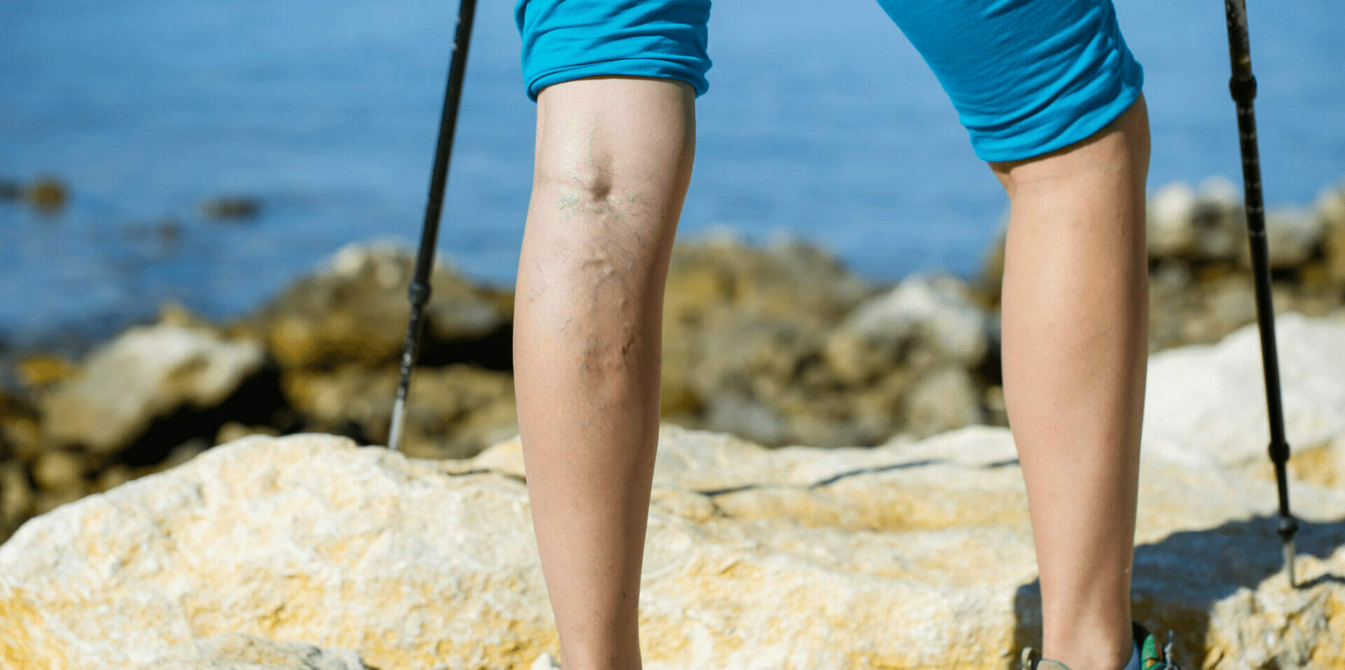 Varicose Vein Treatment In West Byfleet.jpg