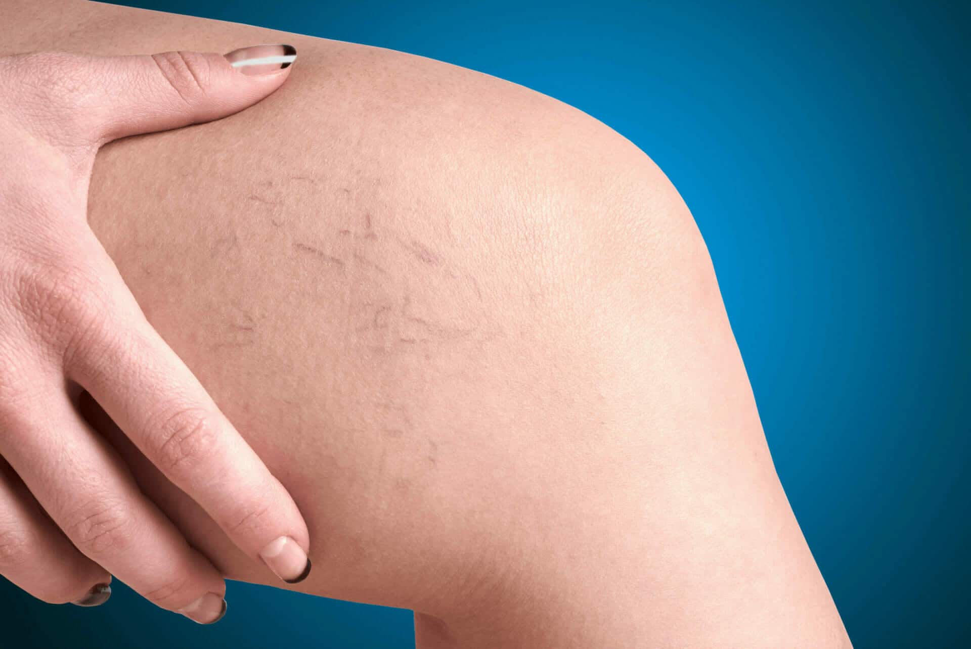 Varicose Vein Treatment In West Byfleet2.Jpg