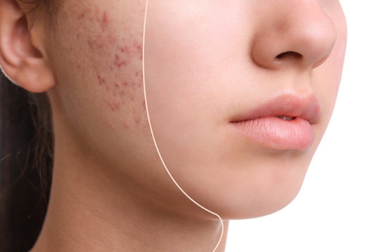 Acne treatment banner