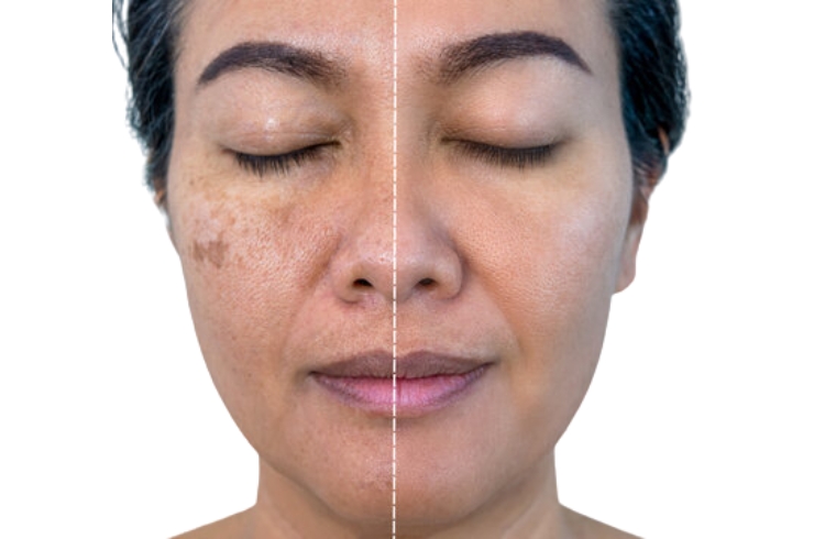 Melasma treatment banner