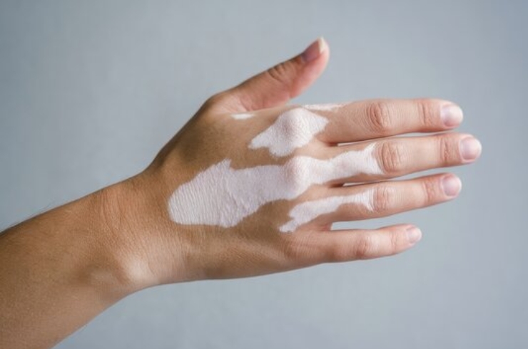 Vitiligo cure banner