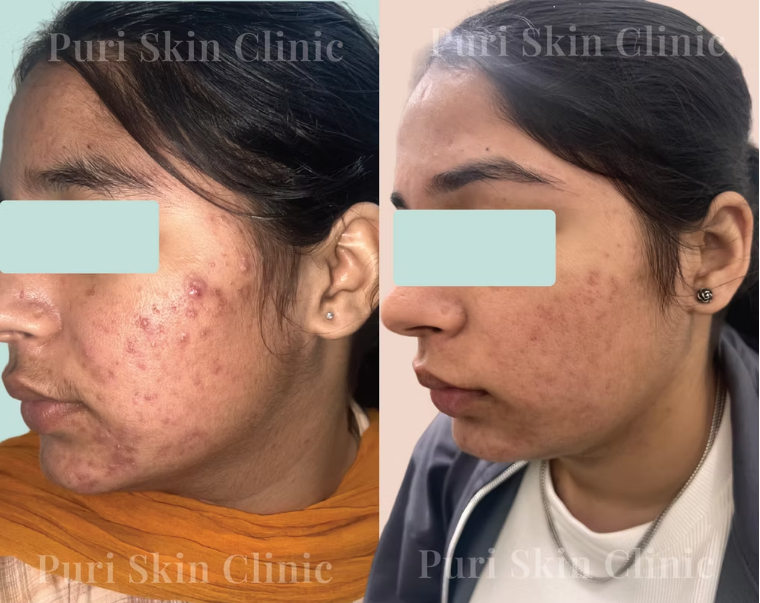 patient's acne treatment results