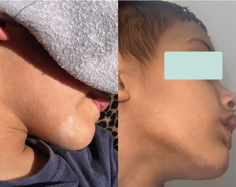 Patient result after vitiligo treatment
