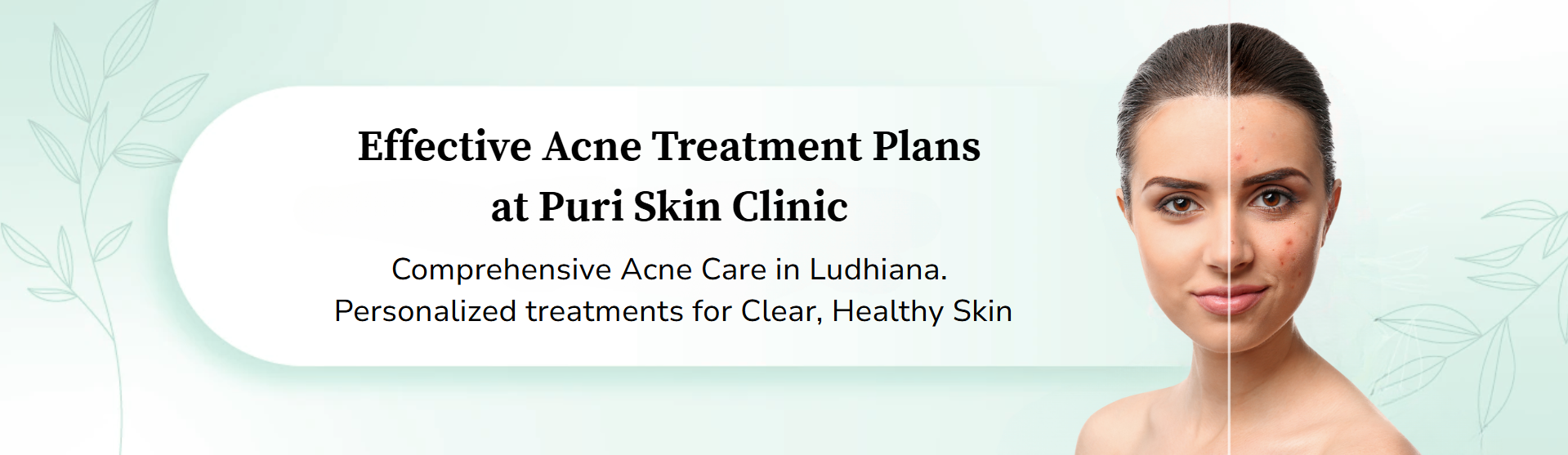 Sffectivew acne treatment plans at Puri Skin Clinic
