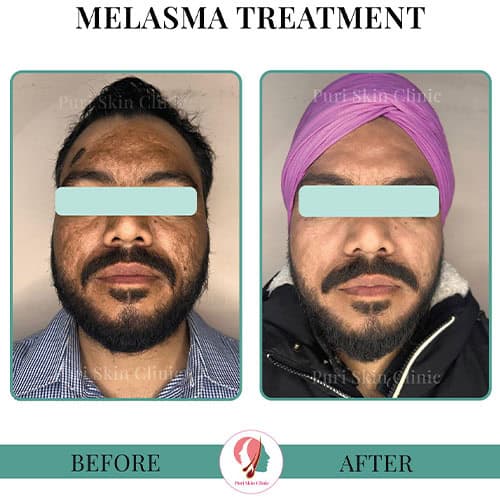 da 0000 hair 3 0000 melasma 5