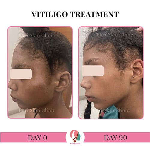 da 0000 hair 3 0000 vitiligo 2