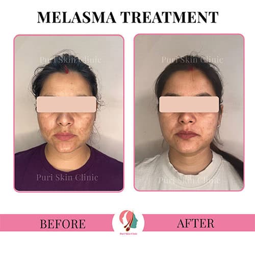 da 0000 hair 3 0001 melasma 6