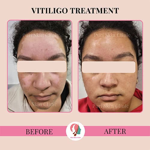 da 0000 hair 3 0001 vitiligo 3