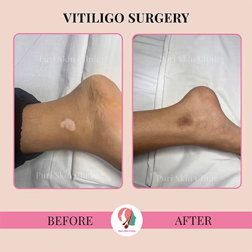 da 0000 hair 3 0002 vitiligo 5