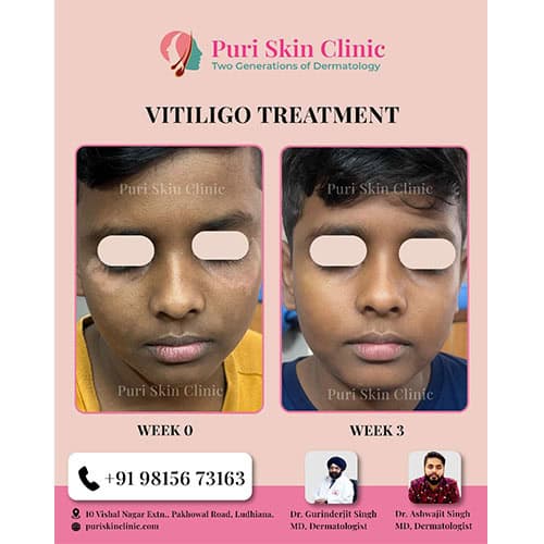 da 0000 hair 3 0004 vitiligo 7